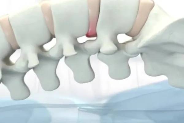 Vista 3D anatómica de columna vertebral mostrando una hernia discal (segmento rojo) entre las vértebras, base biomecánica del tratamiento SDV